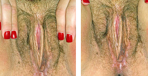 October 2007. Photo Taken 7 months post-op