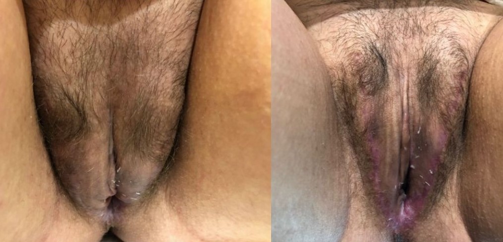 Surgery 2018. Less than 8 weeks postop. Barely visible scars, beautiful labia minora, fat mobilization to both labia majora. Overall, almost flawless. Patient is orgasmic.